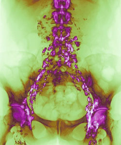 Hodgkin's Lymphoma