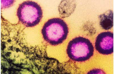 Umbilical Blood Stem Cell Transplant Puts Woman in HIV Remission