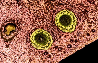 Cancer cells purged from human ovarian tissue fragments by pharmacological inhibition of YAP/TAZ oncoproteins 